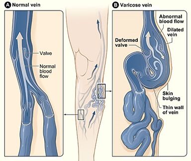 Levicose restores blood vessel walls