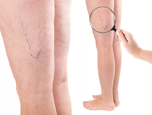 Intravenous veins in women