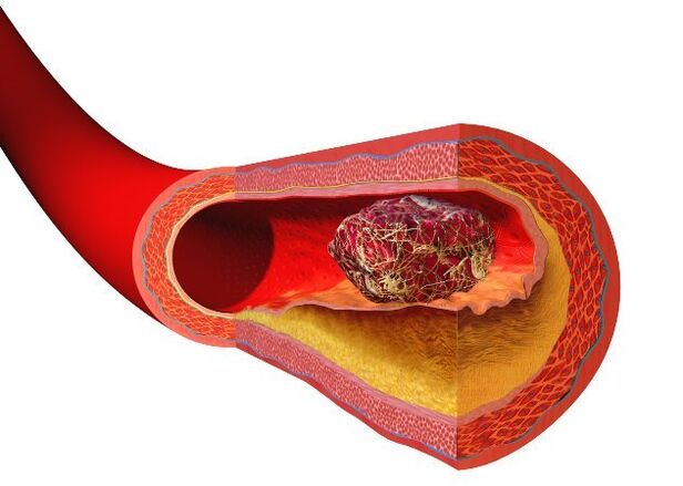 thrombosis