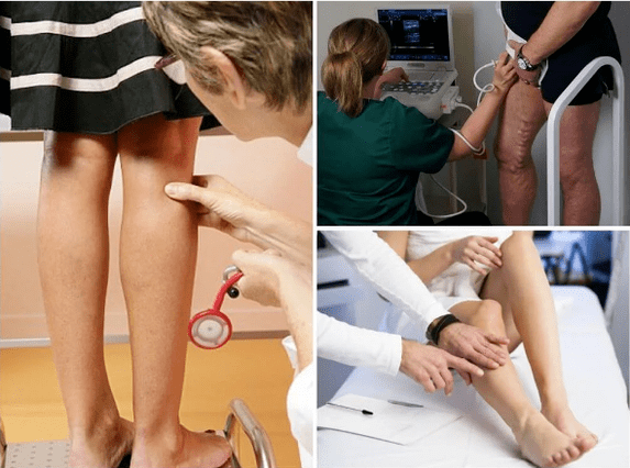 Intravenous veins on the legs