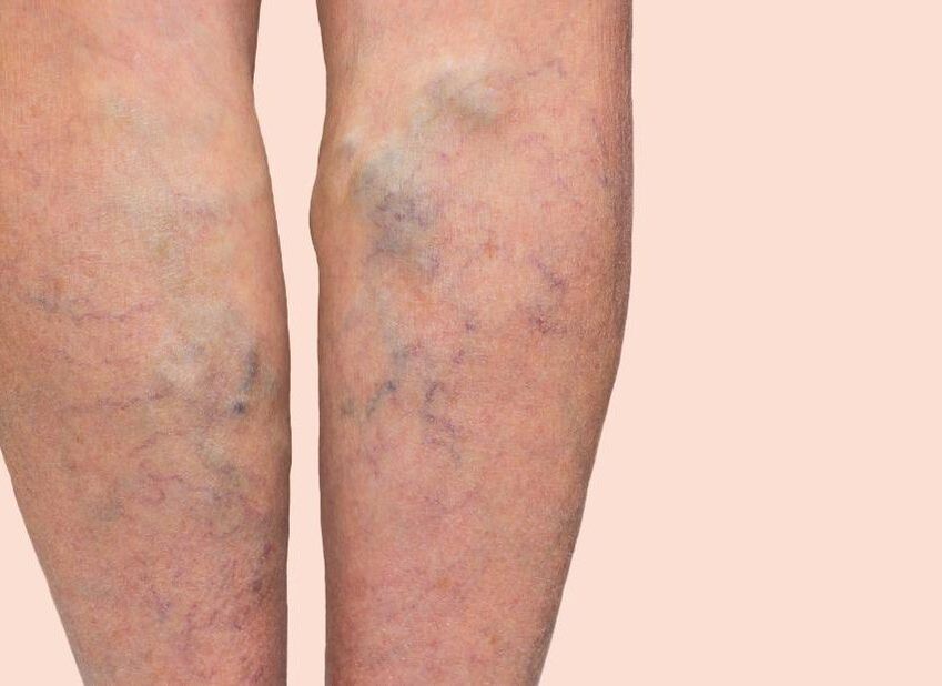 What do the veins look like