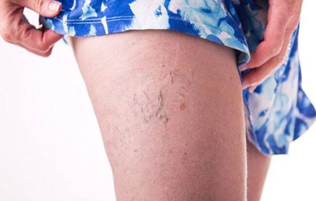 Intravenous veins on the legs