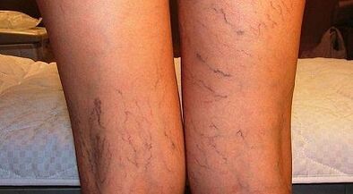 How to treat varicone expansion for women in women