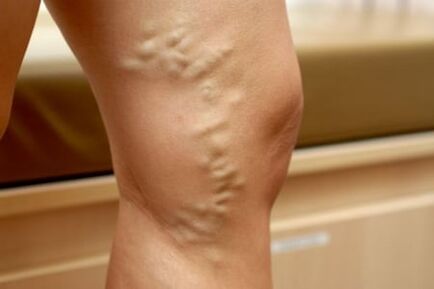 medicine to treat varicose veins