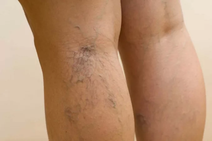 Venous disease in the legs