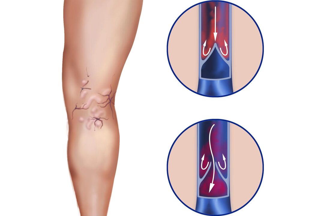 Varicose veins in legs