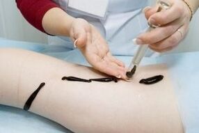 Leech application to treat varicose veins