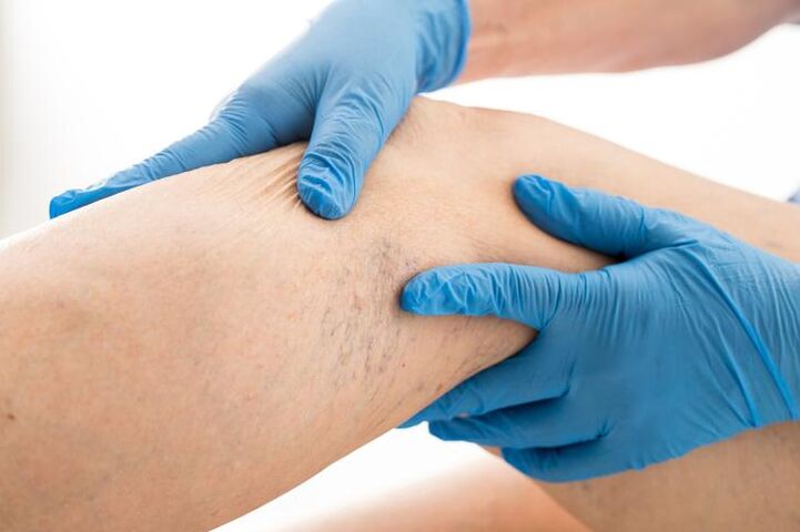 Doctor examining varicose veins