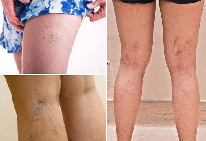 Varicose veins in legs