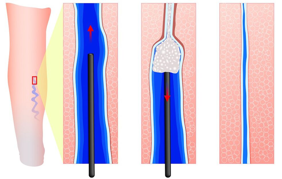 Mechanism of sclerotherapy treatment