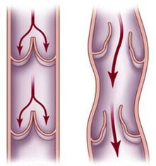 Healthy veins and blood flow are impaired in varicose veins