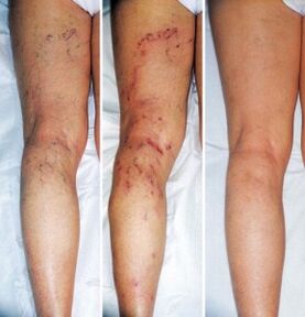 Results of treatment of varicose veins of the lower limbs