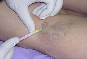 Sclerotherapy is a treatment for varicose veins in the legs