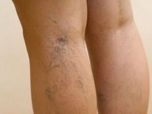 Veins that appear under the skin are a symptom of varicose veins in the legs