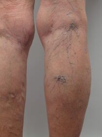 With varicose veins of the lower limbs, tortuous veins protrude above the surface of the skin