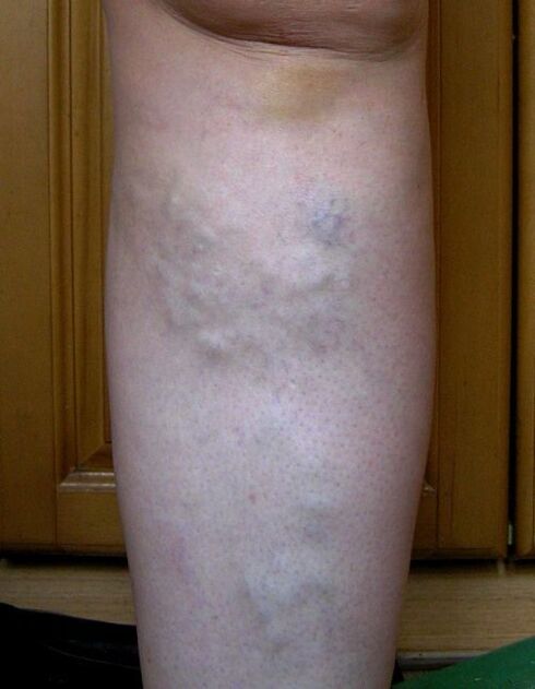 Swollen veins in the legs due to varicose veins