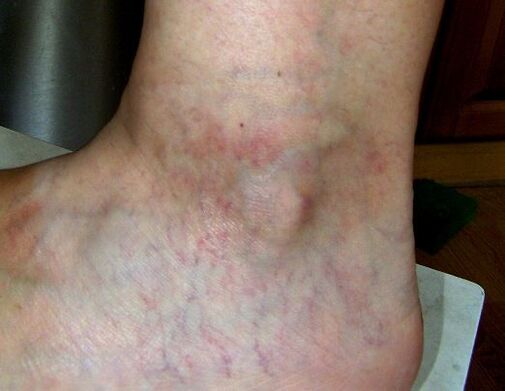 Symptoms of varicose veins of the lower limbs